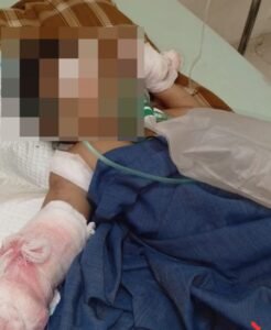 Luka Tak Hanya di Tubuh: Tangan Balita di Bima Diamputasi, Dugaan Malapraktik Mencuat